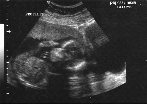 Week 32: Baby's Position: Understanding Fetal Presentation in Week 32